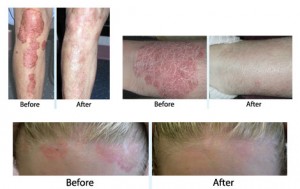 Topical corticosteroid treatment for vitiligo